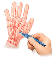 Clinician annotating hand anatomy icon representing personalized intake and context capture.