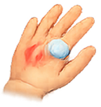 Bandaged left hand icon representing acute hand injury and early recovery.